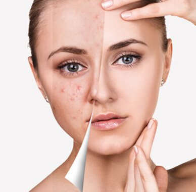 Acne Treatment